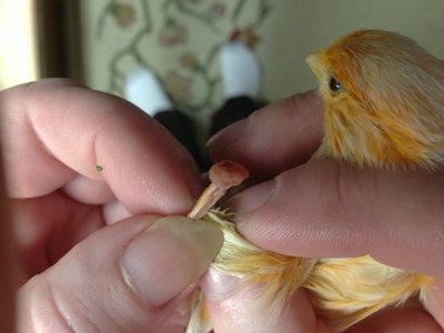 Bows leg after foot amputation 1.JPG